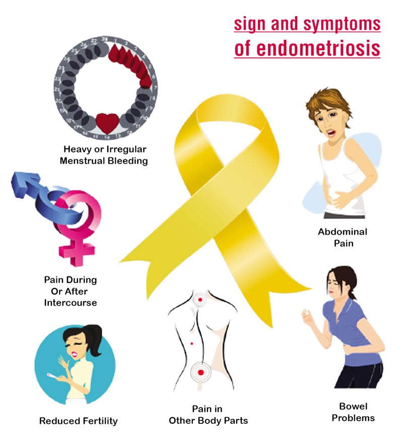 endometriosis